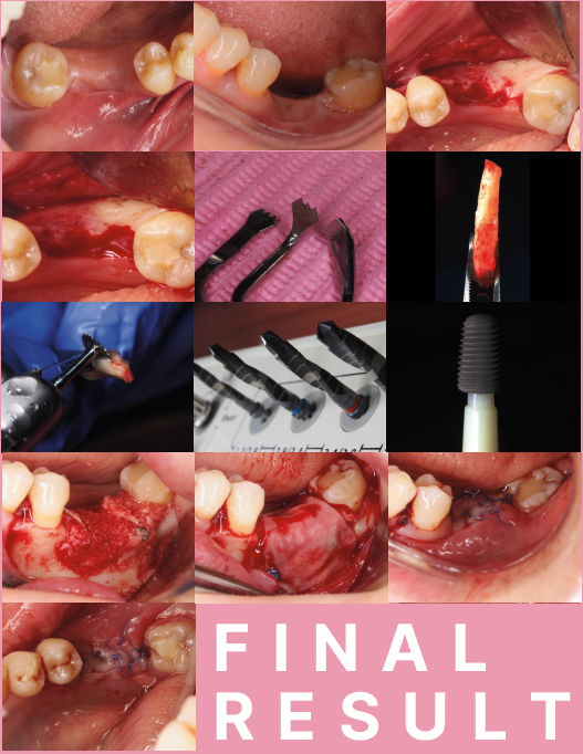 Guided Tissue Regeneration